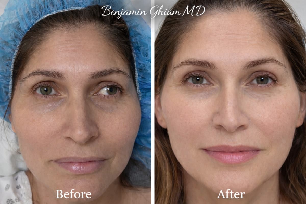 Patient with strabismus before corrective surgery on the left, and the same patient with aligned eyes after surgery on the right